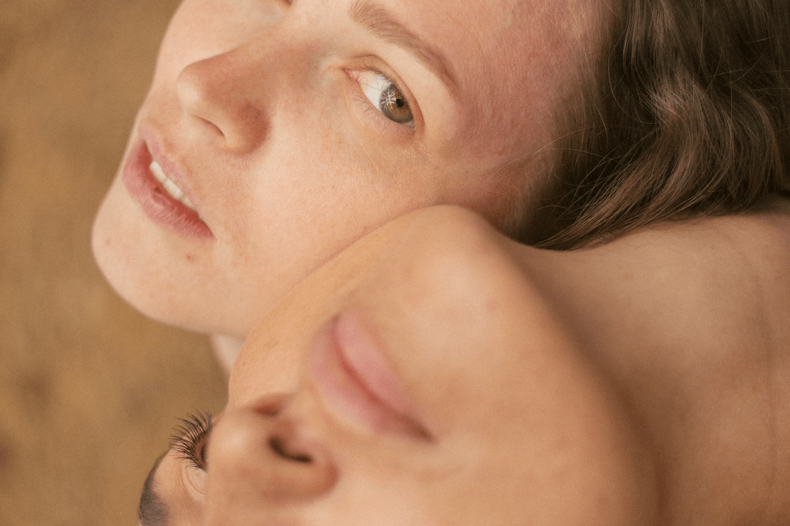 IPL treatment for diffuse redness and broken capillaries